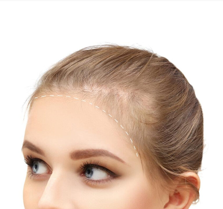 przerzedzenie-wlosow-i-wypadanie-wlosow-lysienie-typu-zenskiego-przeszczep-wlosow(1)